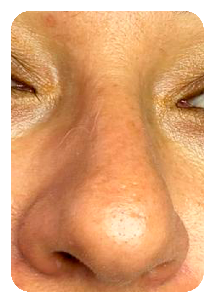 Foto um limpeza de pele antes.