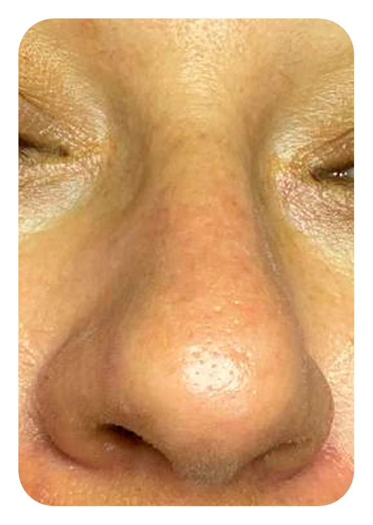 Foto um limpeza de pele depois.