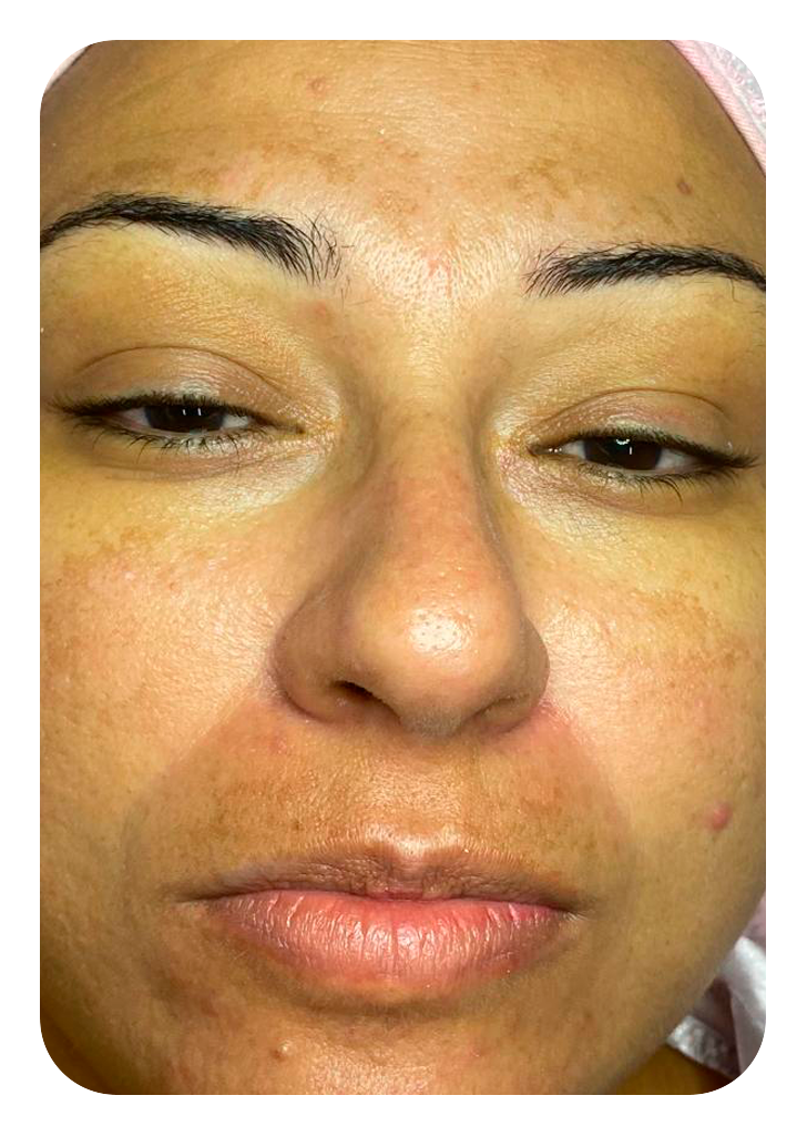 Foto um limpeza de pele depois.