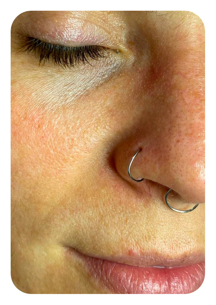 Foto um limpeza de pele antes.