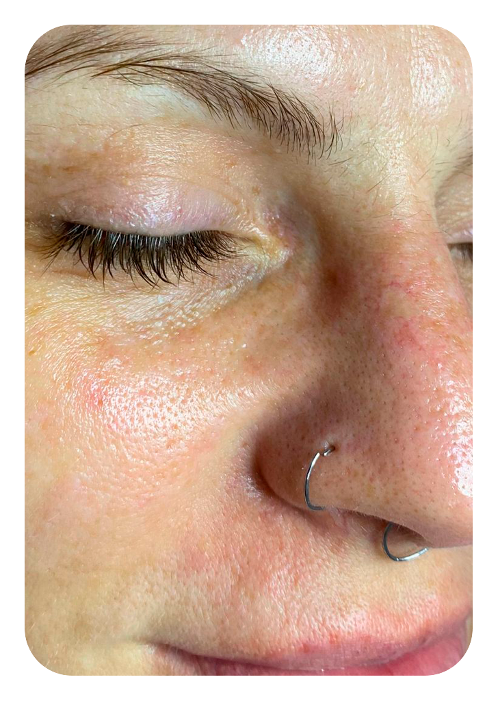 Foto um limpeza de pele depois.