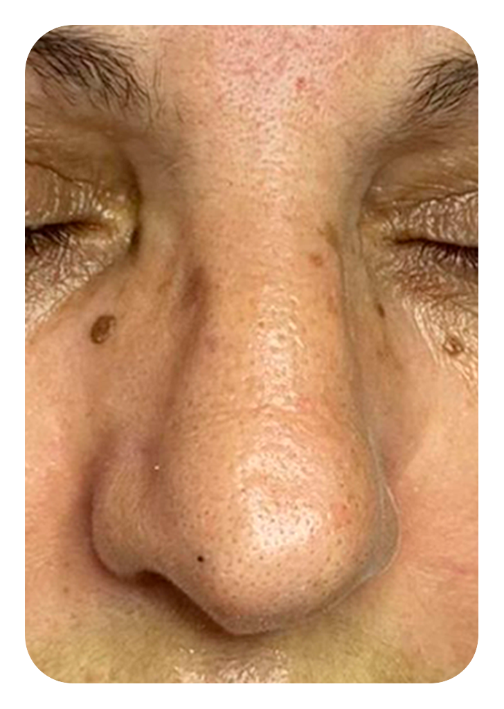 Foto um limpeza de pele antes.