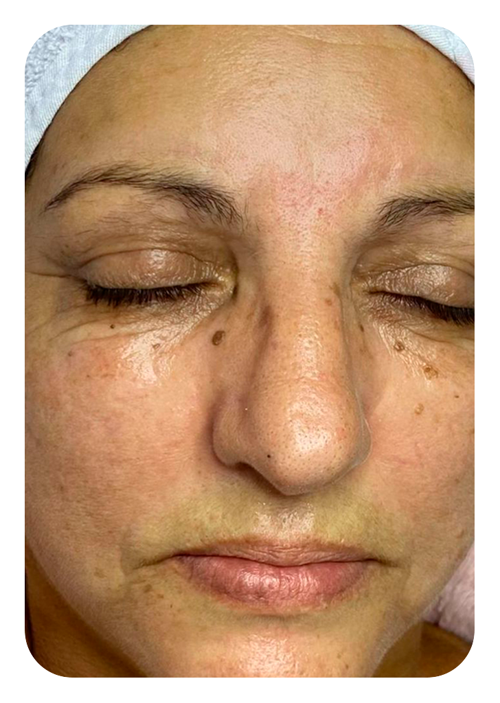 Foto um limpeza de pele antes.