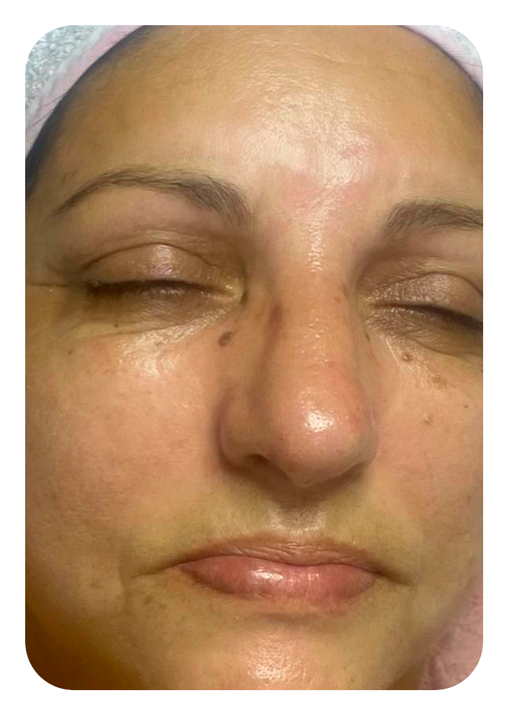 Foto 2 limpeza de pele depois.