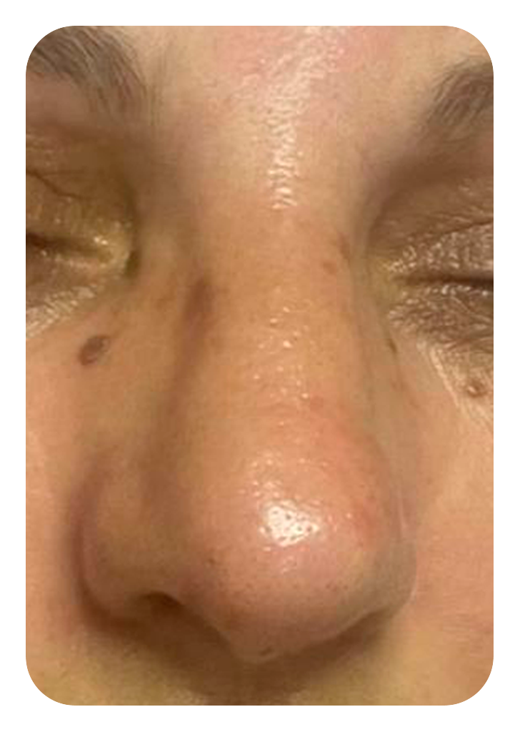 Foto um limpeza de pele depois.