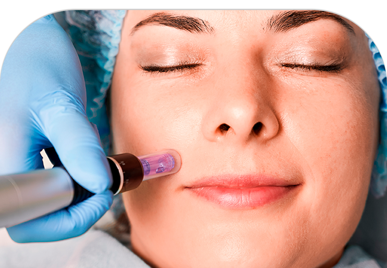 Foto Microagulhamento