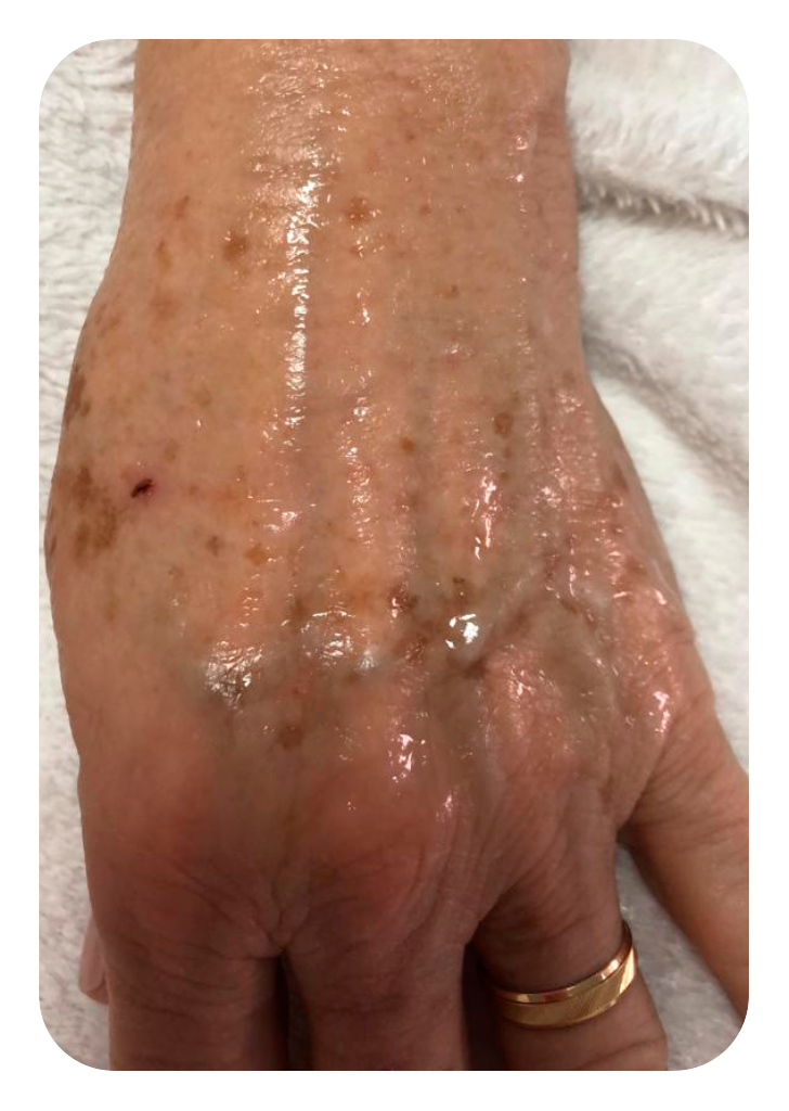 Foto Peeling mão antes