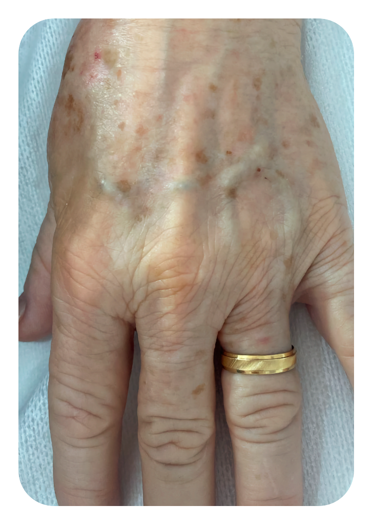 Foto Peeling mão depois